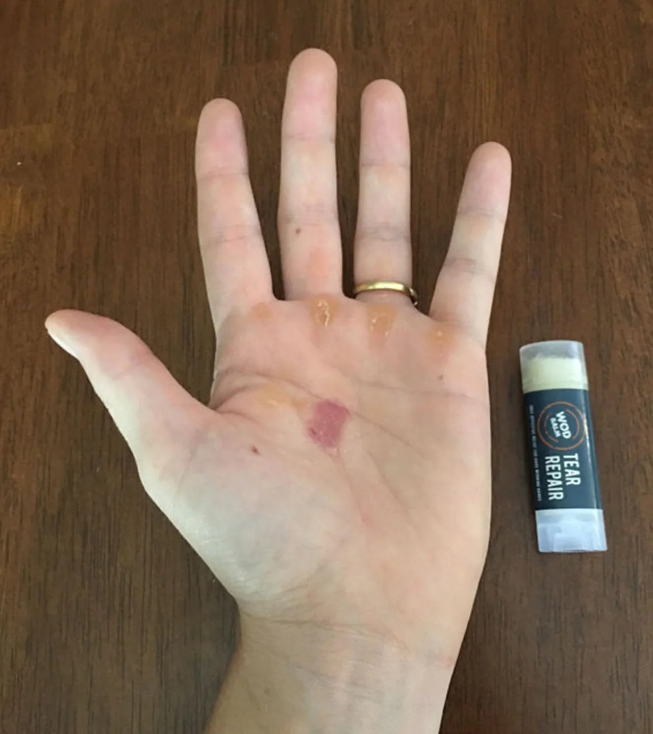 WOD Balm Callus Care Kit - 100% All Natural - Healing Aid For Blisters, Dry, Cracked and Torn Skin - Minor Burns, Cuts and Abrasions - wodarmour